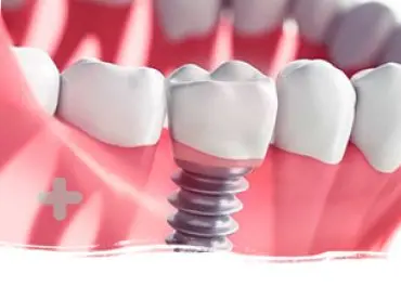 Diagrama de implante dental integrado en el hueso maxilar
